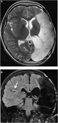 Auditory Processing after Early Left Hemisphere Injury: A Case Report